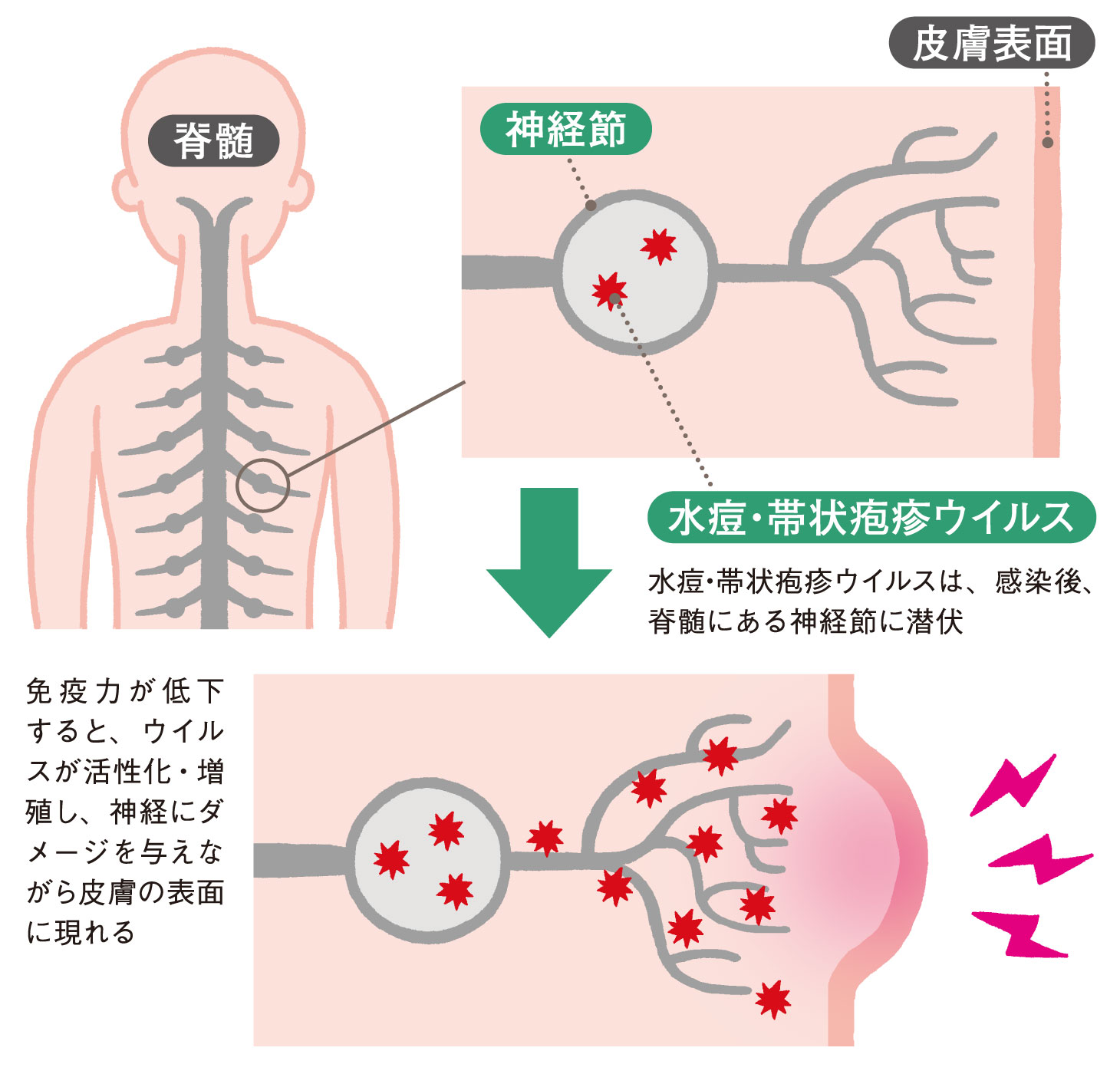 水痘・帯状疱疹ウイルスが神経節に潜伏し、免疫低下で再活性化して皮膚表面に症状が出る仕組み図（脊髄・神経節・皮膚を図解）