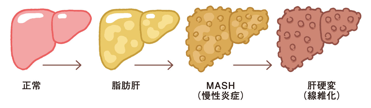 正常な肝臓から脂肪肝、MASH（慢性炎症）、肝硬変（線維化）へ進行するイメージ図