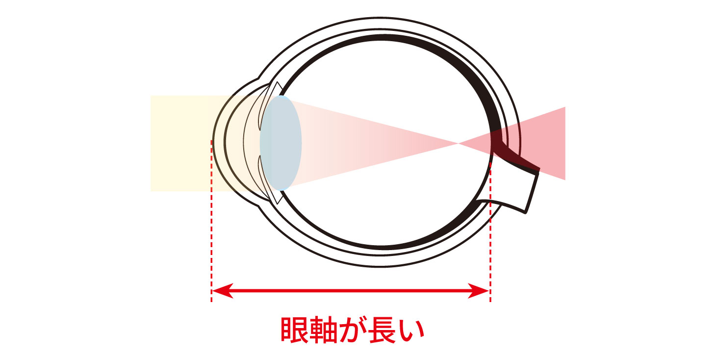 近視の仕組み（眼軸が長くなり網膜の手前でピントが合う状態）