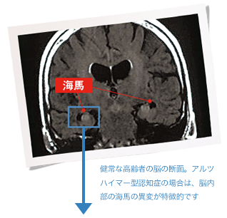 健常な高齢者の脳の断面。アルツハイマー型認知症の場合は、脳内部の海馬の異変が特徴的です