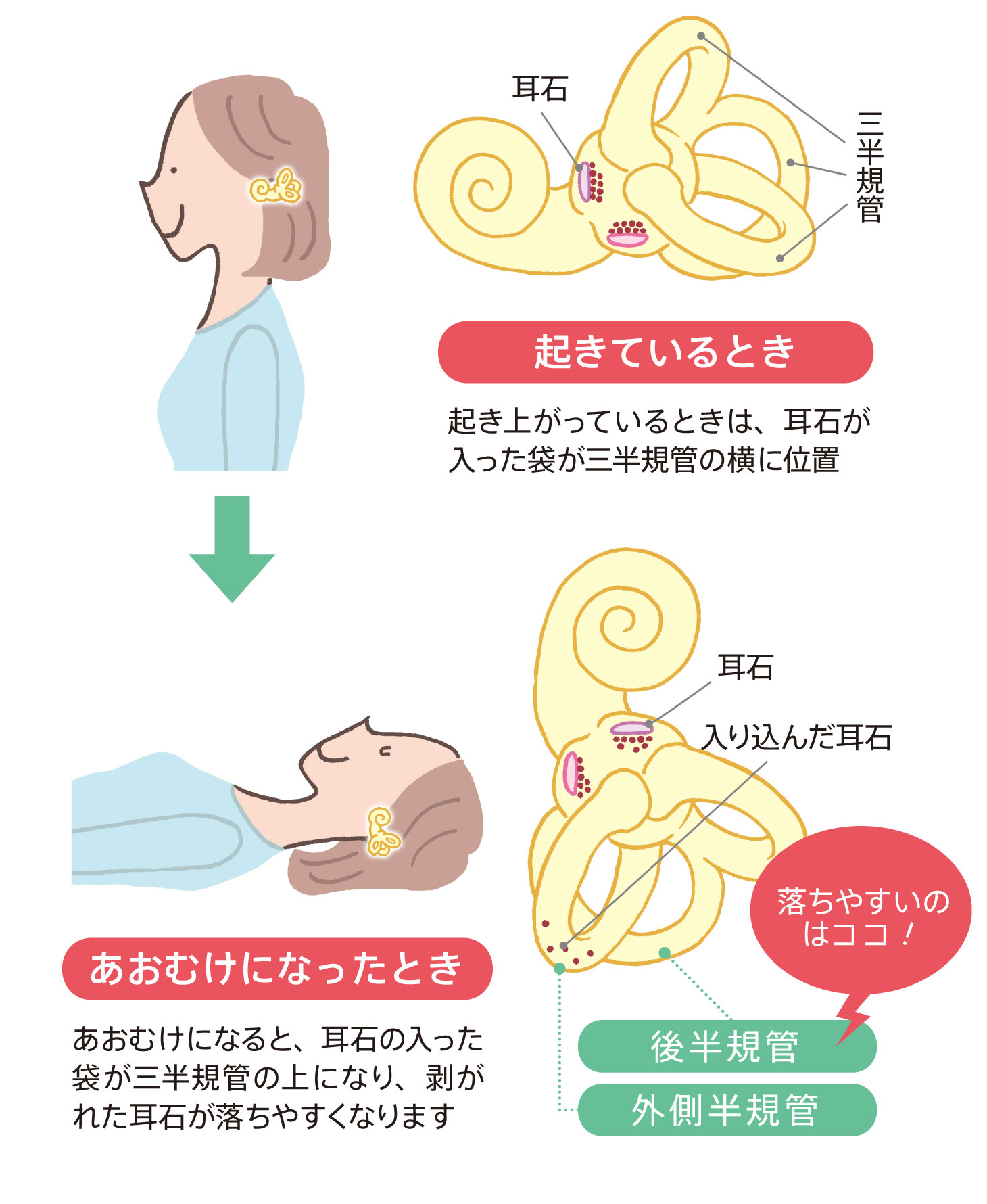 耳石が落ちやすい位置